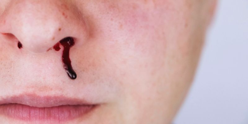 Understanding the Common Causes of Nosebleeds: What You Need To Know